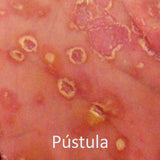 pustula de psoriasis
