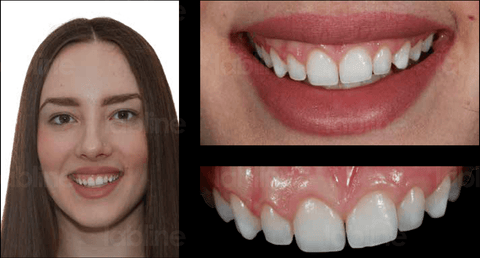 In this case clinical crown lengthening was planned in order to resolve the asymmetry of the gingiva followed by full arch bleaching for 3 weeks.