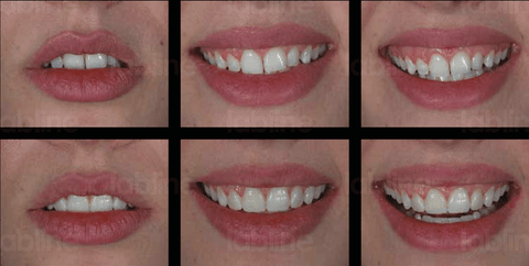 The correction of the midline and the linear axes of the teeth can be easily seen in the smile photos after the mock-up procedure.