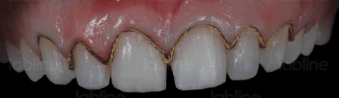 Double cord impression technique was used in this case in combination with PVS impression material.