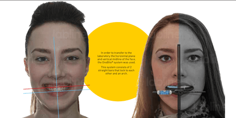 In order to transfer to the laboratory the horizontal plane and vertical midline of the face, the OneBite® system was used. This system consists of 2 straight bars that lock to each other and an arch.