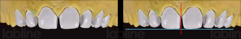 Alveolar model with the refractory dies.