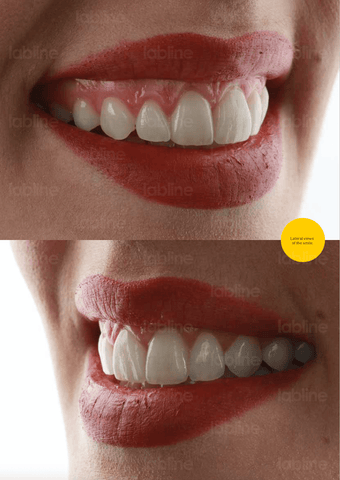 Lateral views of the smile. Labline OneBite