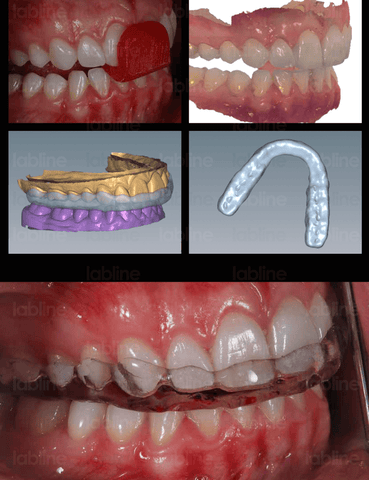 It is important for the maintenance of the therapeutic result to provide the patient with a night guard in order to protect the veneers.  In this case, an intraoral digital impression was taken and a splint was fabricated using CAD/CAM technology without any analog procedures. Orthotic, labline, onebite, Nondas Case Study
