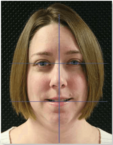 Figure 1: The facial midline, interpupillary line and incisal line should be in symmetrical harmony (note minor nasal asymmetry).