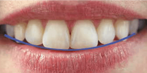 Figure 2: The smile arc shows the anteriors in harmony with the curvature of the lower lip.