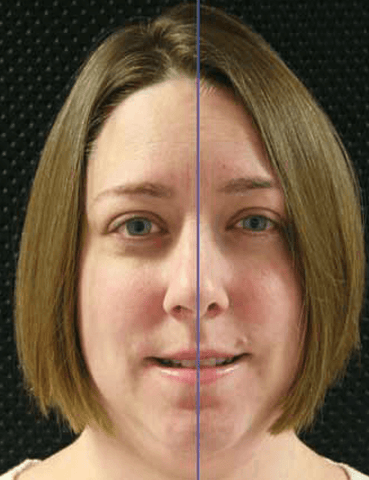 Figure 3: The facial and dental midline should coincide for optimum esthetics.