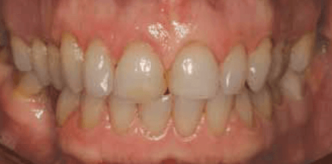 Figure 4: This patient’s midlines do not coincide, thus the mandibular midline cannot be used as a reference point for the final restorations.