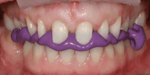 Figure 6: The dental technician cannot use the mandibular midline to decide where to place the maxillary midline when multiple teeth are prepared.