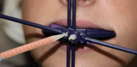 Figure 17: For illustrative purposes, the angulation of the horizontal bar has been exaggerated and fixation is achieved with Temptation acrylic temporary material (Clinician’s Choice).
