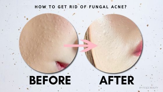 fungal-acne-safe-sunscreen