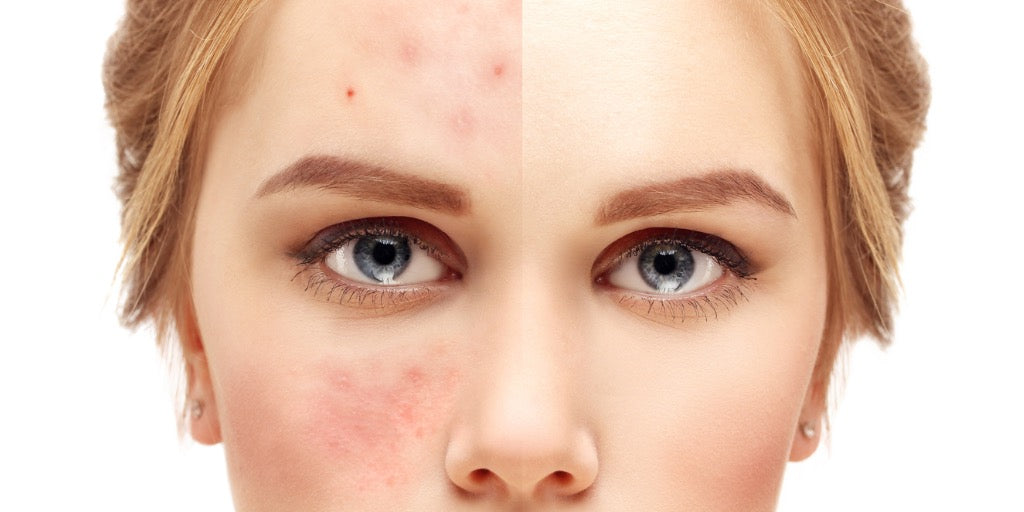 young woman's face half with acne half without acne