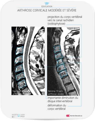 Discarthrose : arthrose cervicale modérée et sévère