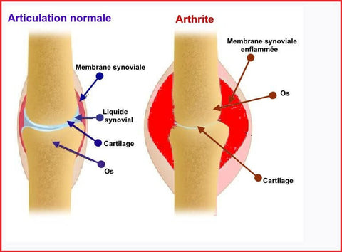 Articulation normale comparée à arthrite avec membrane synoviale enflammée. 