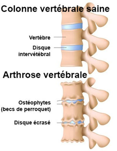 Arthrose cervicale ou cervicarthrose : discarthrose de la colonne vertébrale