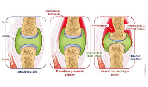 Rhumatisme psoriasique : articulation saine, inflammation de l'articulation, inflammation de la membrane synoviale et réduction du cartilage