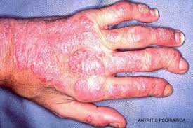 psoriasis