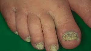psoriasis en la uñas
