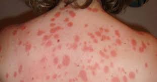 psoriasis de gotas