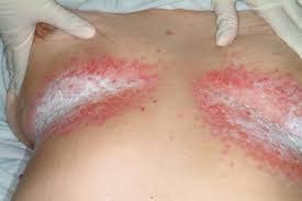 psoriasis inversa