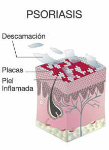 que es la psoriasis 