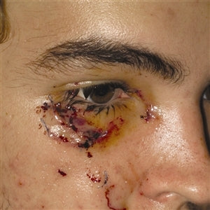 Staph infection treatment ciprofloxacin eye Staph infection treatment ciprofloxacin eye