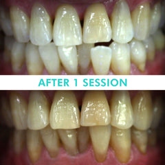 Mint Smilebar, Power Whitening Kit, LED Teeth Whitening Before and after