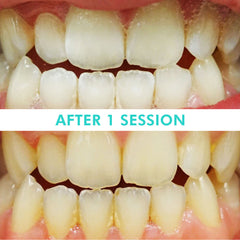 Mint Smilebar, Power Whitening Kit, LED Teeth Whitening Before and after