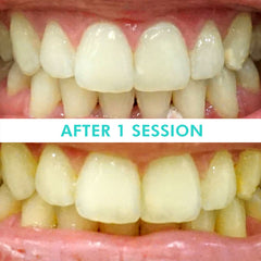 Mint Smilebar, Power Whitening Kit, LED Teeth Whitening Before and after