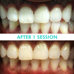 Mint Smilebar, Power Whitening Kit, LED Teeth Whitening Before and after