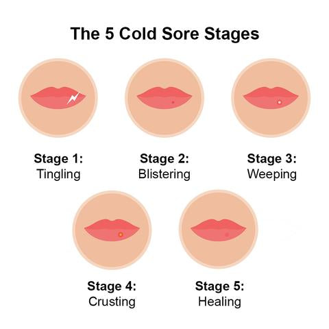 The 5 Cold Sore Stages: A Step-by-Step Guide – Luminance Red