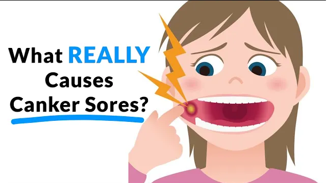 What Causes Canker Sores Causes Treatment And Prevention Luminance Red