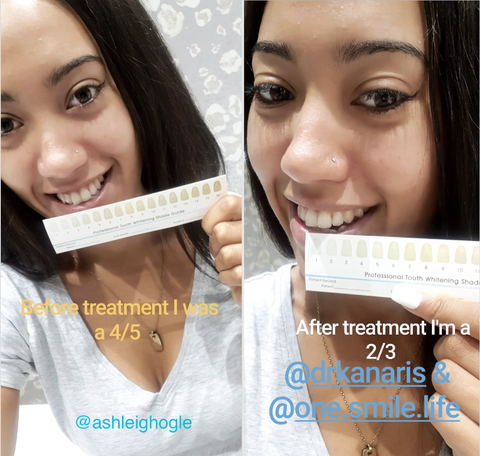 One Smile Teeth Whitening Kit Before and After