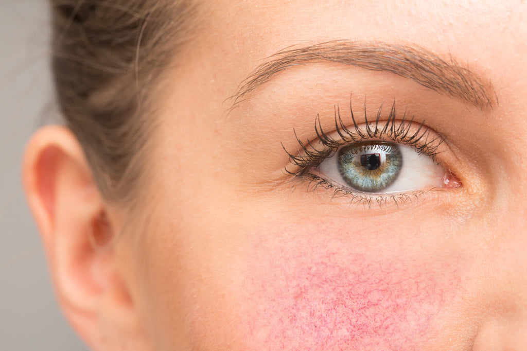 Rosacea Symptoms Causes And Treatment Oxygenetix 