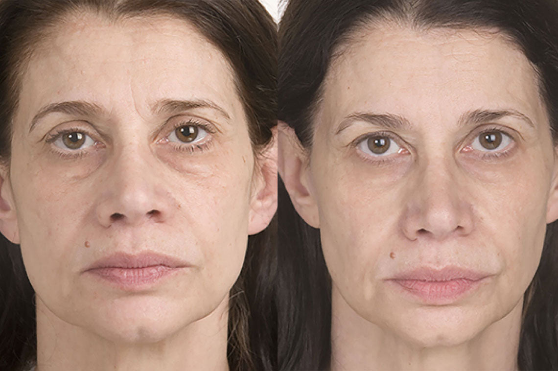 46 year old woman before and after Miracle 10