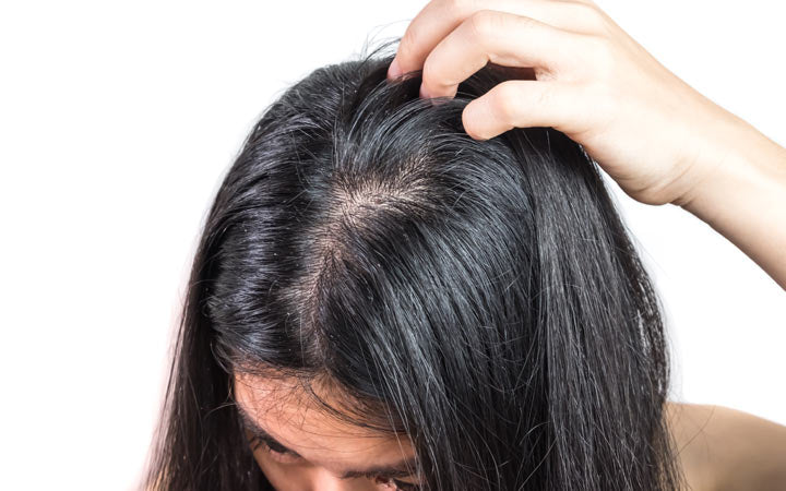 Oily & Greasy Scalp? Try These Holistic Ayurvedic Treatments! – Vedix