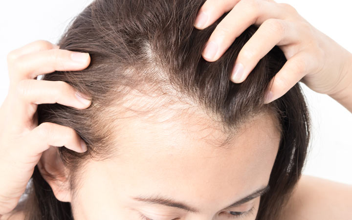 women with serious hair loss problem