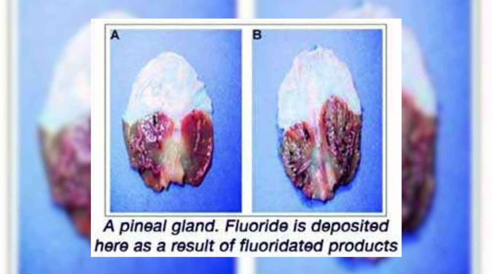 PINEAL GLAND