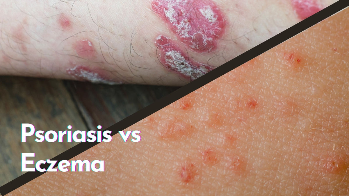 Whats The Difference Between Psoriasis And Eczema 