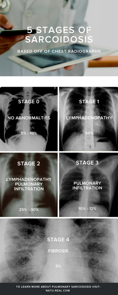 Stages of Pulmonary Sarcoidosis Natureal