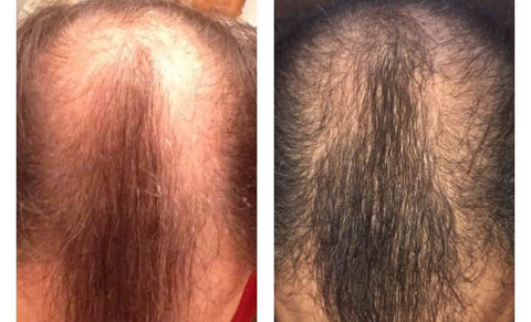 microneedling hair growth