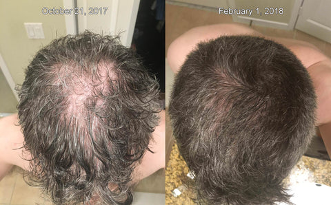 microneedling hair growth