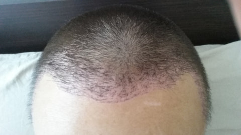 hair transplant recipient zone