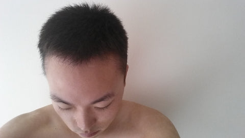 hair transplant hair growth