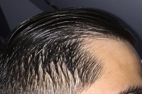 microneedling hair growth