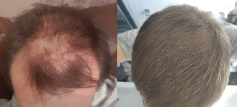 microneedling hair growth