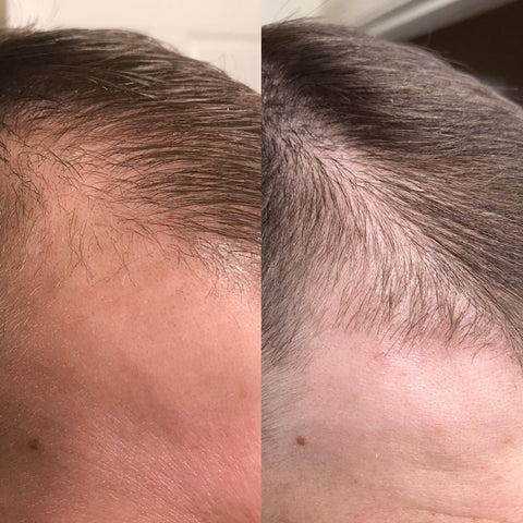 microneedling hair growth