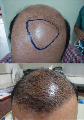 body hair transplant 