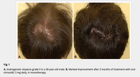 oral minoxidil, minoxidil, hair loss, hair transplant