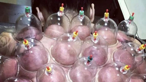 Hijama therapy cupping 